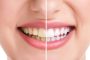 ۱۰ علت بدرنگی دندانها و راههای جلوگیری از آنها